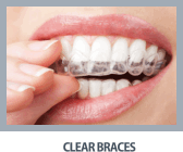 Clear Braces